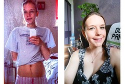 Bobot Cuma 31 Kg Dikira Anoreksia, Ternyata Claire Kena Crohn Disease