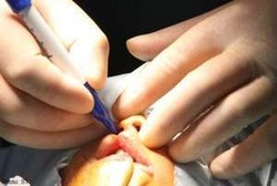 Terapi Wicara Juga Punya Peranan Penting Pasca Operasi Bibir Sumbing