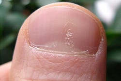 Kuku Melepuh Dikira karena Infeksi Biasa, Ternyata Pria Ini Kena Herpes