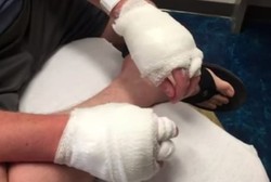 Kena Reaksi Alergi Langka, Pria Ini Kena Luka Bakar Saat Bikin Minuman