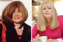 Kisah Louise, Wanita dengan Kelainan Pembuluh Darah yang Mengubah Wajahnya