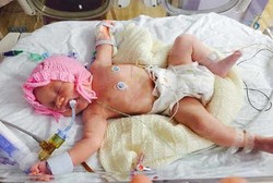 Perut dan Usus Naik ke Rongga Dada, Bayi Ini Berhasil Bertahan Hidup