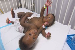 Ini Dia Kembar Siam yang Sukses Dipisahkan Pertama Kali di Haiti