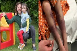 Sembuh dari Cacar Air, Kaki Bocah Ini Malah Membiru dan Hampir Diamputasi