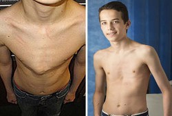 Dada Menonjol seperti Burung Merpati, Remaja Ini Nyaris Putus Asa