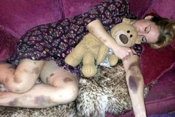 Lebam Sekujur Tubuh, Wanita Ini Ternyata Kena Kanker Darah Langka