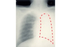 Dikira Cuma Batuk Berat, Paru-paru Lei Ternyata Tersumbat Tutup Pulpen