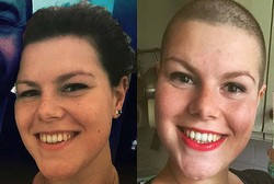 Gadis Ini Botaki Kepalanya untuk Hentikan Kebiasaan Mencabuti Rambut