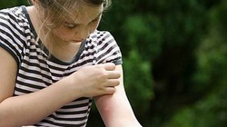 Gara-gara Makan Keju dan Keripik Anda Bisa Jadi Sasaran Gigitan Nyamuk (1)