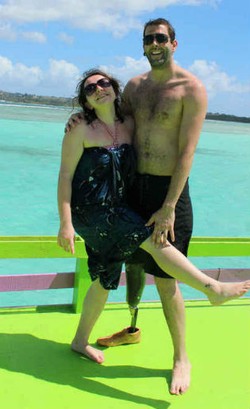 Kaki Diamputasi, Pria Ini Pakai Tulangnya Untuk Hiasi Cincin Tunangan