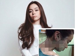 Begini Kondisi Fabioli Setelah Disiram Air Keras