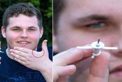 Remaja yang Tanam Chip di Tangannya untuk Kendalikan Perangkat Teknologi