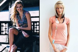 Idap Kondisi Langka, Tubuh Lisa Kurus dan Bobotnya Tak Bisa Bertambah