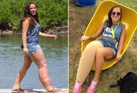 Potret Isa-Bella, Gadis Cantik dengan Kaki Besar Sebelah