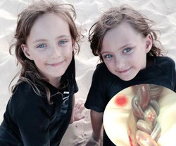 Keajaiban Bayi Kembar dengan Tali Pusat Saling Mengikat yang Terlahir Sehat