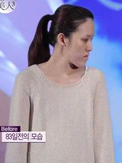 Sulit Dapat Pekerjaan, Wanita Ini Operasi Potong Rahang