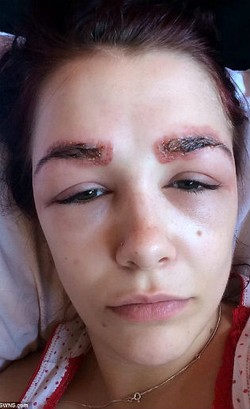 Alis Gadis Ini Malah Bengkak dan Bernanah Setelah Prosedur Tebalkan Alis