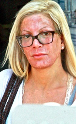 Keluar dari Klinik Kecantikan, Wajah Tori Spelling Merah Seperti Terbakar