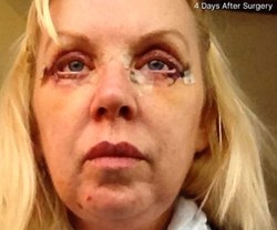 Operasi Plastik Gagal, Wanita Ini Tidur dengan Mata Terbuka