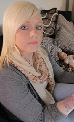 Ingin Hilangkan Tato, Kulit Jessica Malah Terbakar dan Mengelupas