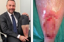 Digigit Laba-Laba, Kaki Turis Inggris Ini Nyaris Diamputasi