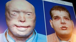 Seorang Pemadam Kebakaran Sukses Mendapatkan Wajah Baru