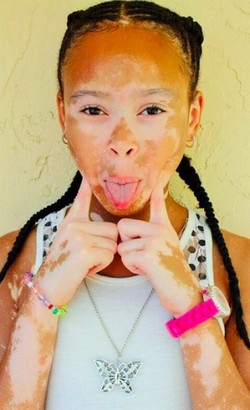 Inilah Model Cilik Berkulit Belang yang Populer di Internet