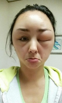 Ingin Ganti Warna Rambut, Kepala Wanita Ini Malah Bengkak Hingga Mirip Alien