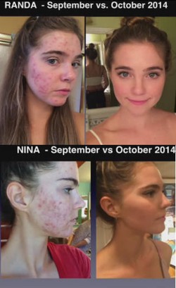 Saudari Kembar Sukses Buat Wajah Berjerawat Mulus dalam 6 Bulan, Ini Tipsnya