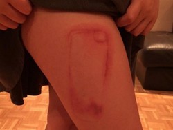 Kasihan, Gadis Ini Punya Tato iPhone di Paha