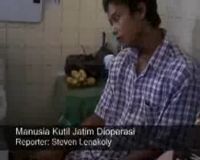 Manusia Kutil Jatim Dioperasi