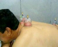 Usir Penyakit dengan Bekam