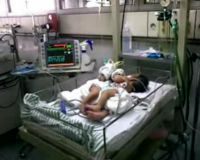 Bayi Kembar Siam Sidoarjo Kritis