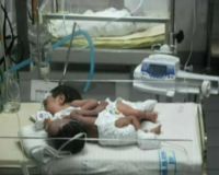 RSU dr Soetomo Kembali Tangani Bayi Kembar Siam