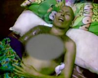 Lala Terbaring Karena Kanker Payudara