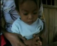 Bocah Penderita Gizi Buruk