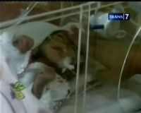 Bayi Gizi Buruk Prematur