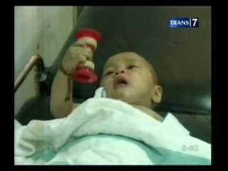 Aisyah, Bayi yang Dipotong Ibunya Kini Membaik