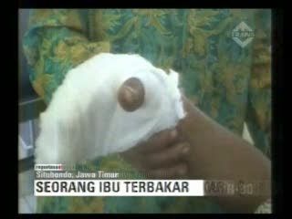 Terbakar Saat Memadamkan Kebakaran Hutan