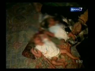 Bayi Kembar Terlahir Tanpa Batok Kepala