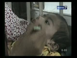 Balita Gizi Buruk Butuh Bantuan