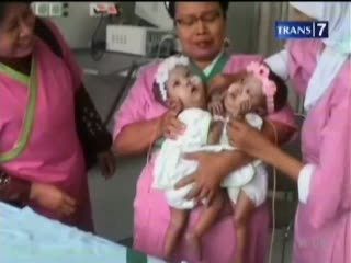 Memiliki Satu Jantung, Bayi Kembar Batal Dipisah