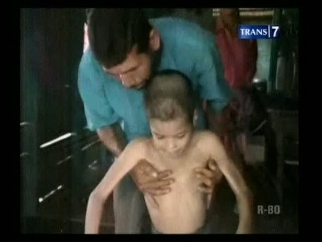  Dua Bersaudara Terkena Penyakit Ganas