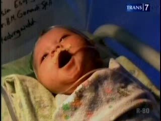 Bayi Kelainan Saluran Pencernaan