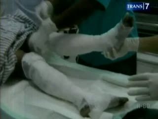 Elpiji Meledak, 5 Orang Terbakar