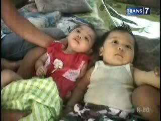  Balita Alami Gizi Buruk