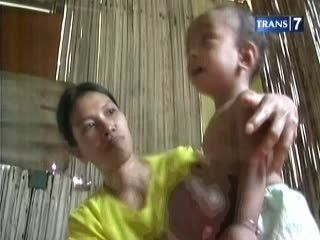 Bocah Perempuan Hidup dengan Usus di Luar