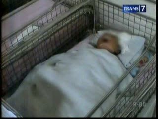 Bayi Lahir Tanpa Batok Kepala