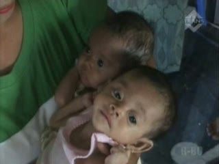 Dua Bocah Kembar Alami Gizi Buruk