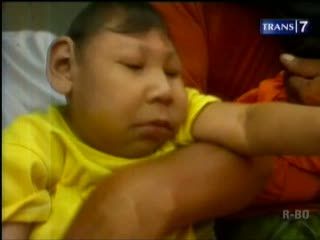 Dua Balita Miskin Hidup dengan Kepala Mengecil